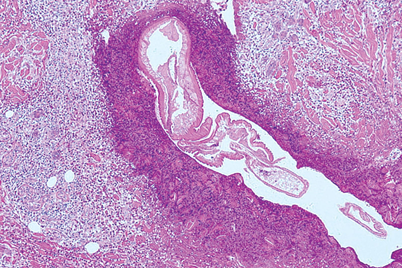 Biopsia de larva en la piel abdominal. CDC-DPD